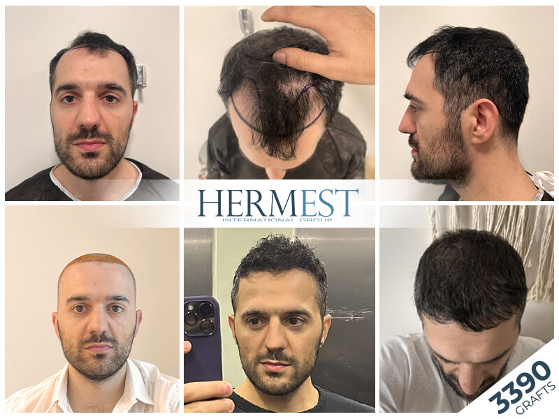 hair-transplant-before-after-1